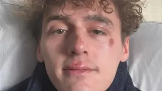 "Big Brother"’s Cameron Cole Fights Back After Homophobic Assault: “You Will Not Win”